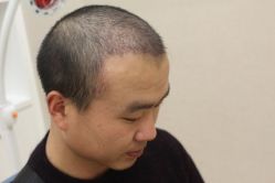 点击看大图 -大麦微针植发丨全国连锁