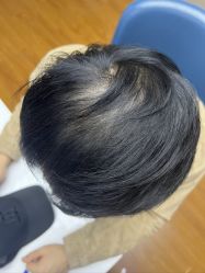 体验后-大麦微针植发全国连锁