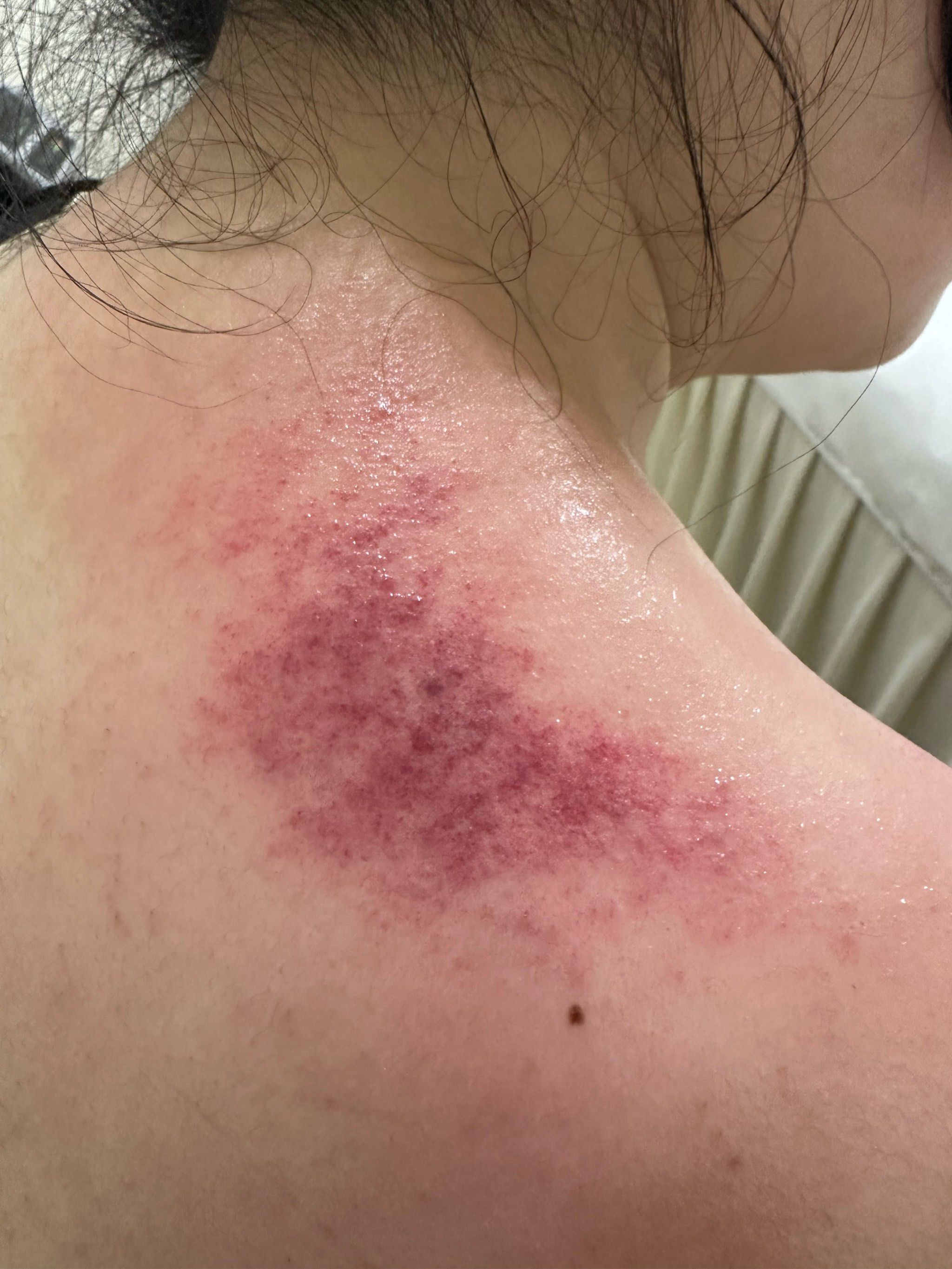 保持健康,从刮痧开始