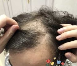 点击看大图 -大麦微针植发全国连锁