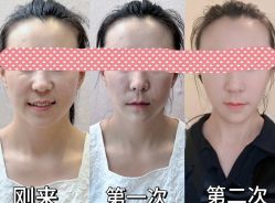 -颜和骨正&明星徒手小颜整骨