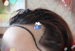 -大麦微针植发全国连锁