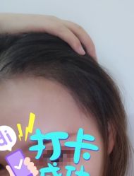 -大麦微针植发全国连锁