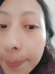 -爱莎扁平疣·汗管瘤·斑痣中心
