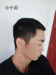 -雍禾植发
