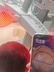 -碧莲盛·不剃发植发