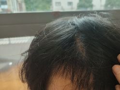 -碧莲盛·不剃发植发