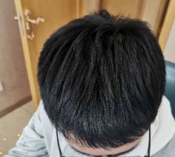 -大麦微针植发丨全国连锁