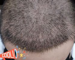 -大麦微针植发丨全国连锁