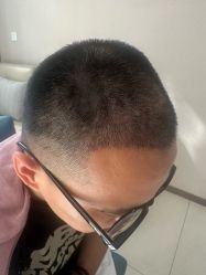-大麦微针植发丨全国连锁