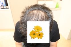 -大麦微针植发丨全国连锁
