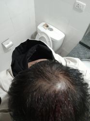-碧莲盛·不剃发植发