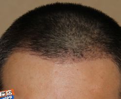 -大麦微针植发丨全国连锁