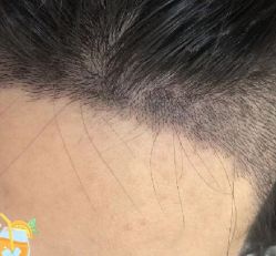 -大麦微针植发丨全国连锁