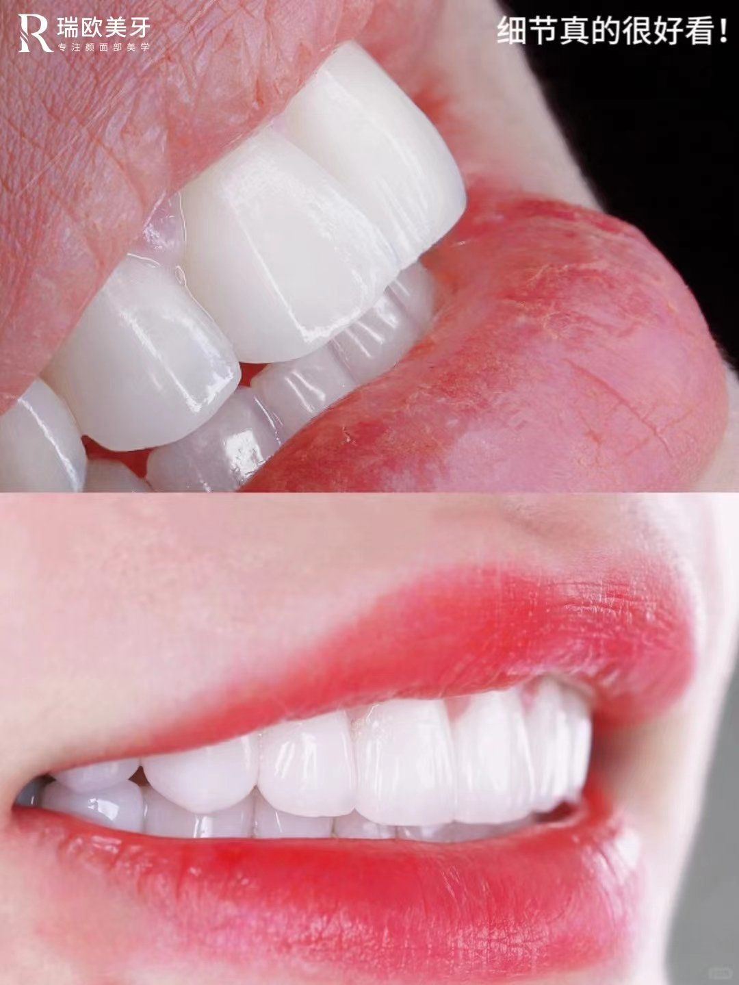 亮白牙齿自然闪耀