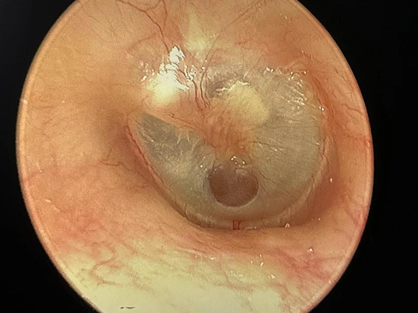 中耳炎,鼓膜穿孔