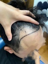 体验前-大麦微针植发全国连锁