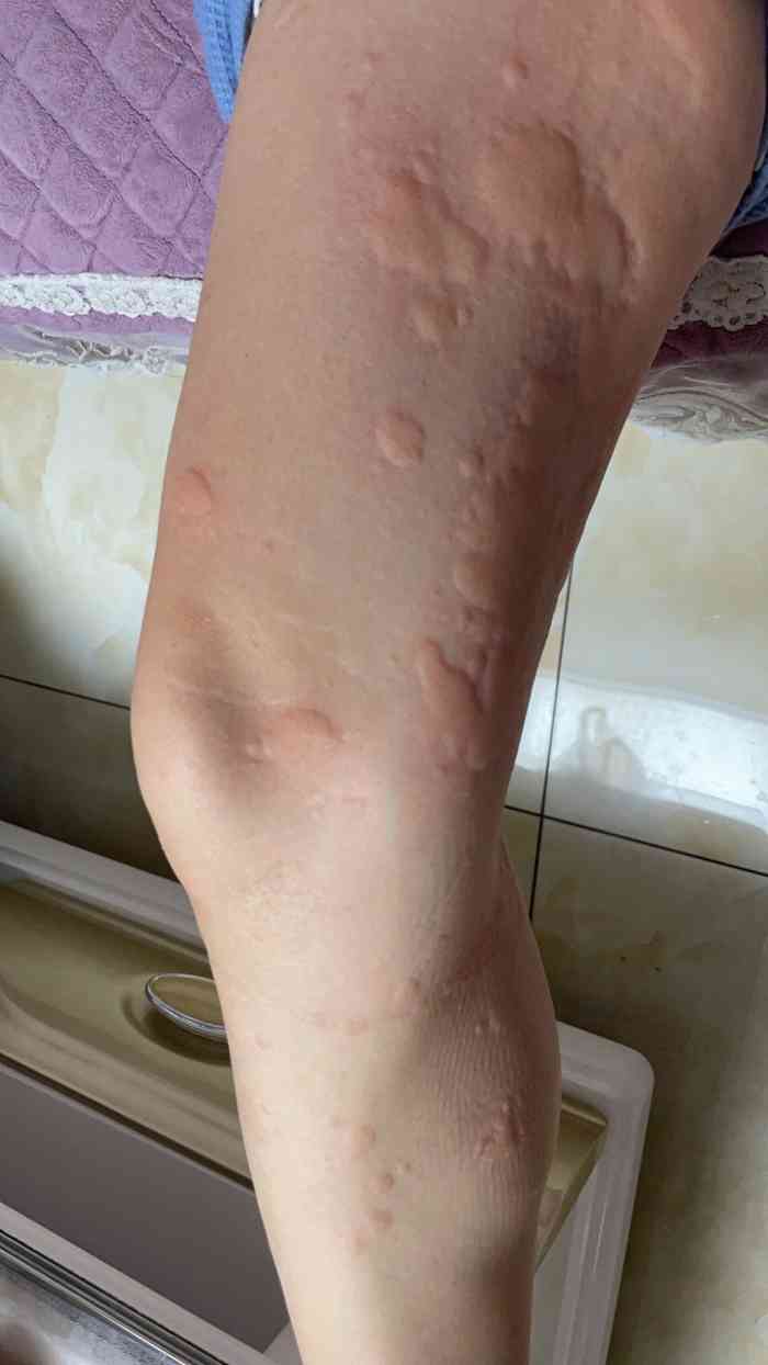 打分 蚊子一堆堆 把我朋友咬的都是红包