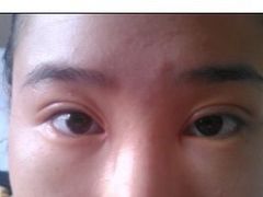 术后第5天-上海华安整形外科门诊部