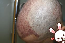 -大麦微针植发丨全国连锁