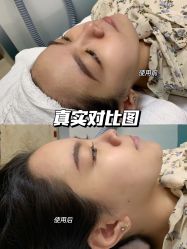 -柠檬一美·Ondapro·轻薄紧致抗衰中心
