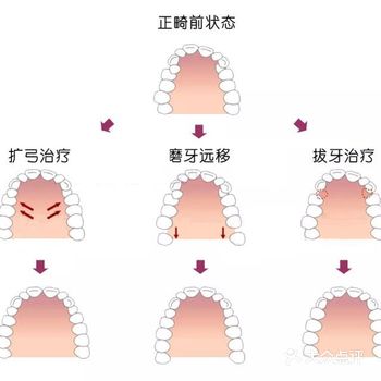 关于牙齿矫正扩弓的那些事!