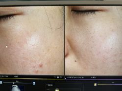 -苑苑vbeauty科技美容SPA