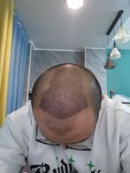体验后-大麦微针植发丨全国连锁