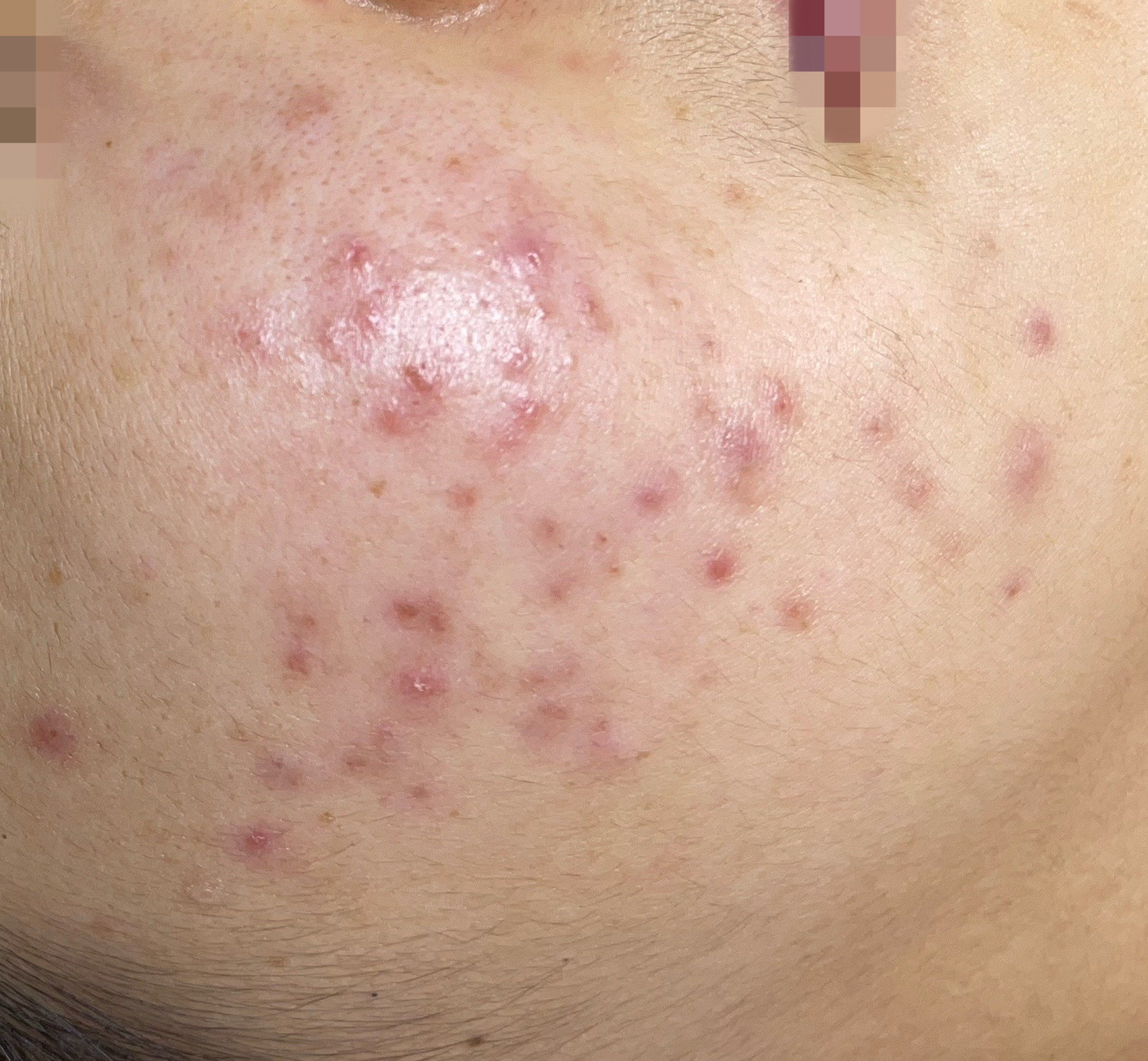 痘痘怎么挤不留痕迹