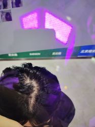 -北京雍禾植发医院