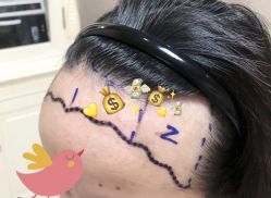 -大麦微针植发全国连锁