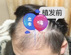 -大麦微针植发全国连锁