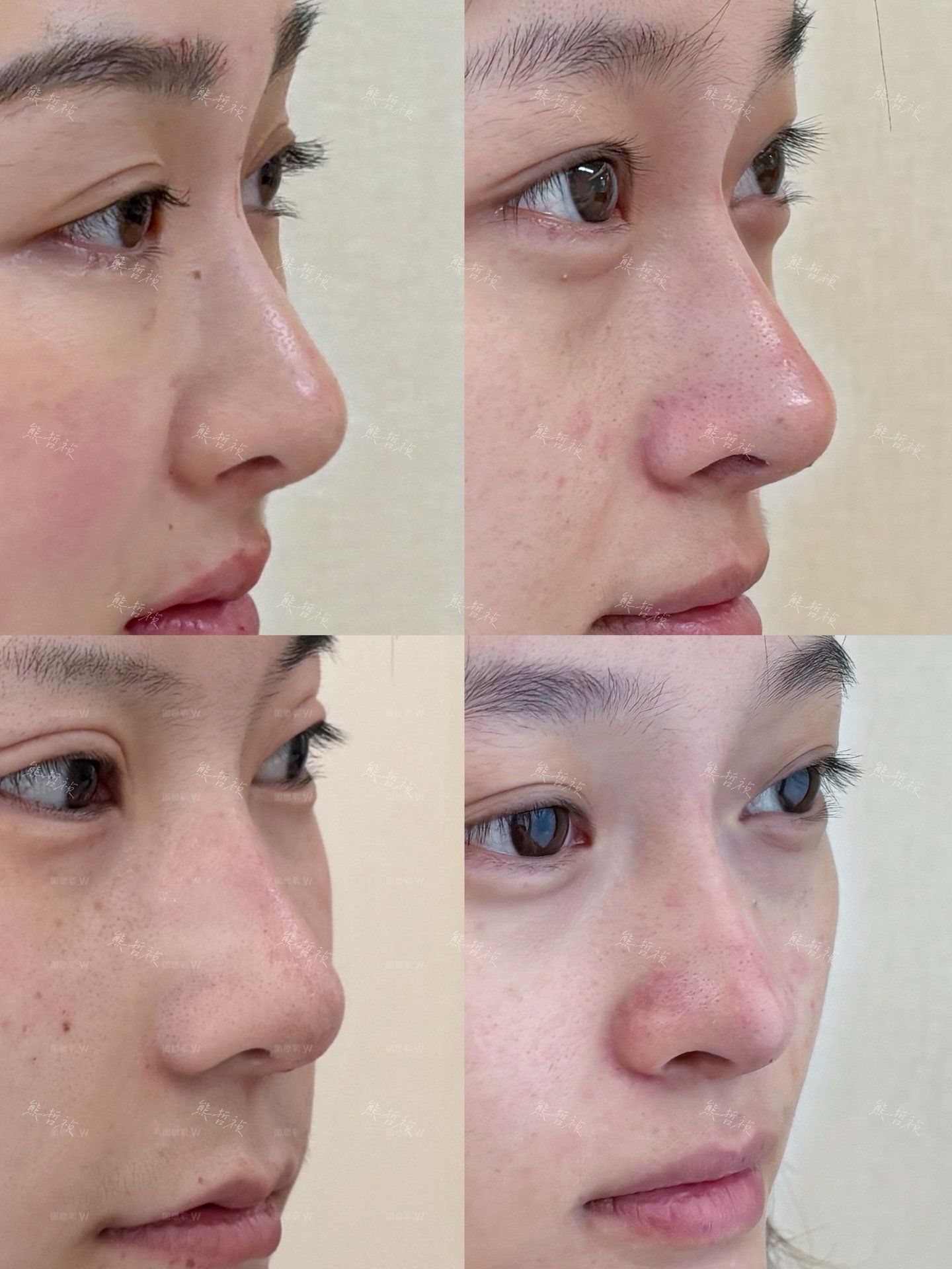 刀注射精致立体鼻91
0整感,妈生感真的好强
从山根—鼻背—鼻头