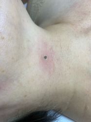 -清疣美疣·痣·斑净肤中心