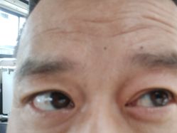 体验后-紫洁俪方（北京）医疗美容