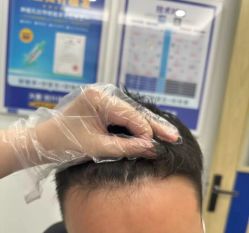 -大麦微针植发全国连锁