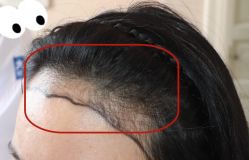 -大麦微针植发全国连锁