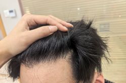 -大麦微针植发丨全国连锁