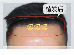 -大麦微针植发全国连锁