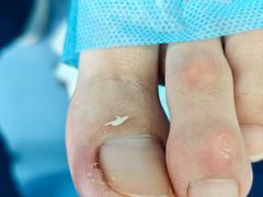 -Andrew指甲专科灰指甲·甲沟炎矫正·3D步态矫形鞋垫定制(浦三路店)