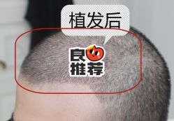 -大麦微针植发全国连锁