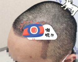 -大麦微针植发全国连锁