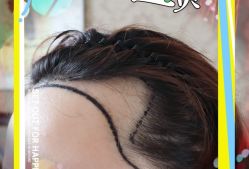 -大麦微针植发全国连锁