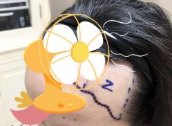 -大麦微针植发全国连锁