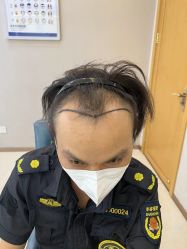 -大麦微针植发丨全国连锁