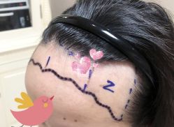 -大麦微针植发全国连锁