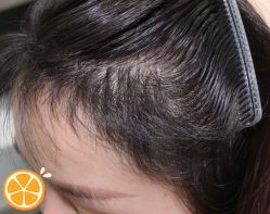 -大麦微针植发丨全国连锁