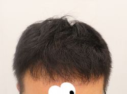 -大麦微针植发全国连锁