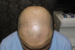 -大麦微针植发丨全国连锁