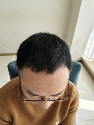 体验后-大麦微针植发丨全国连锁